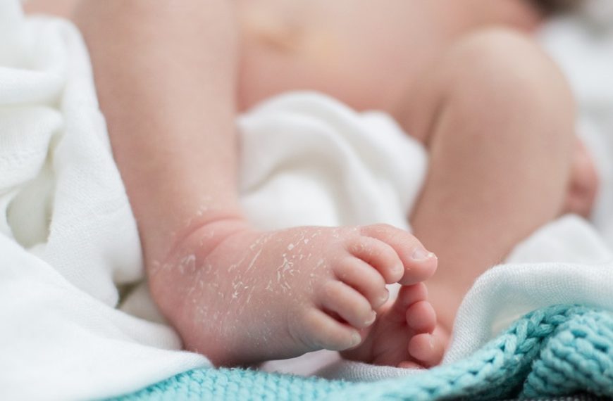 Dry Skin in Babies & Children: Causes & Home Remedies