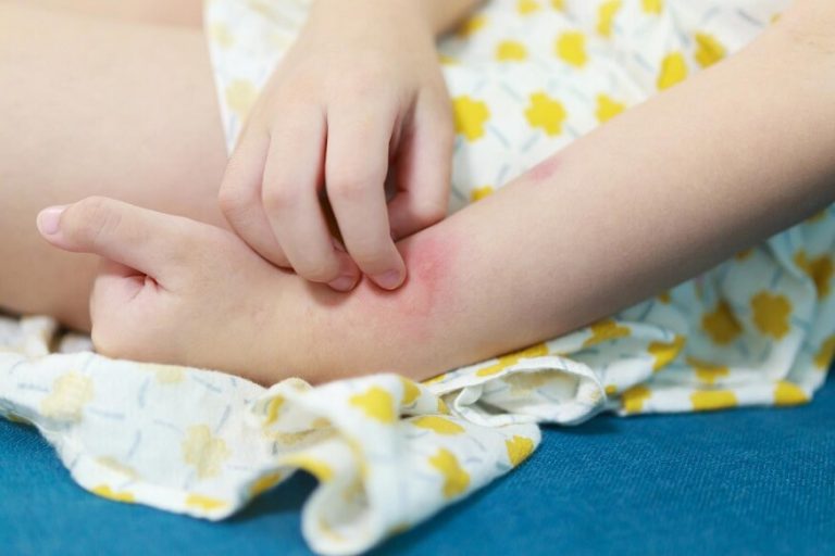 understanding-and-managing-heat-rash-in-kids-causes-prevention