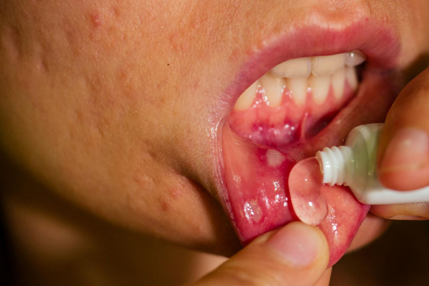 mouth-ulcers-in-babies