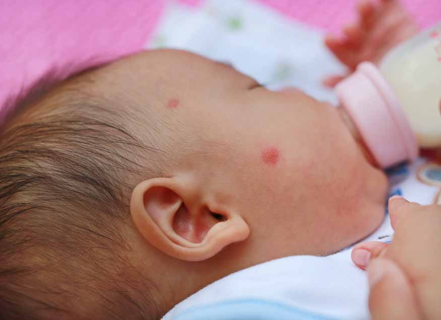 infant-eczema