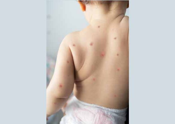 Understanding and Identifying Different Types of Baby Rashes: A Parent’s Guide